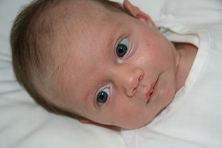 怀孕妊娠合并新生儿湿肺怎么利尿